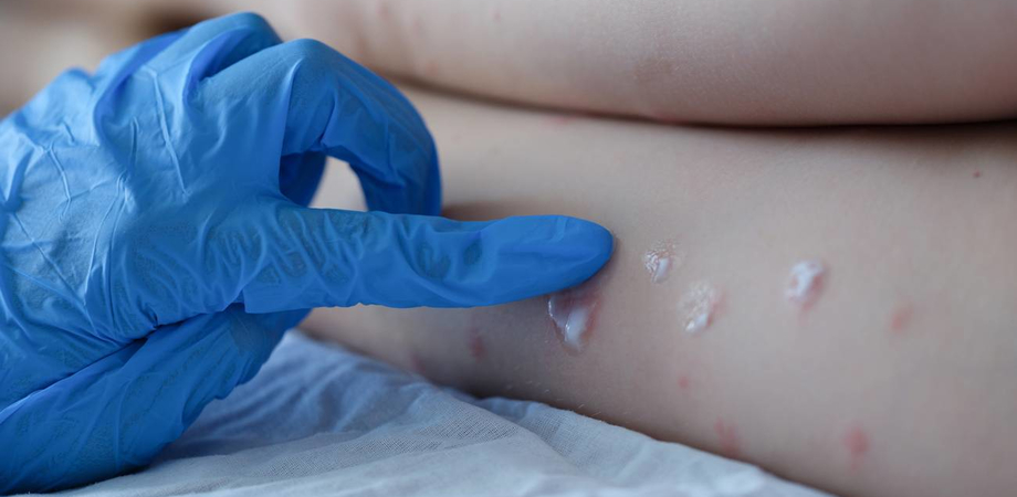 Vaiolo delle scimmie, secondo caso in Liguria: positivo un 26enne genovese