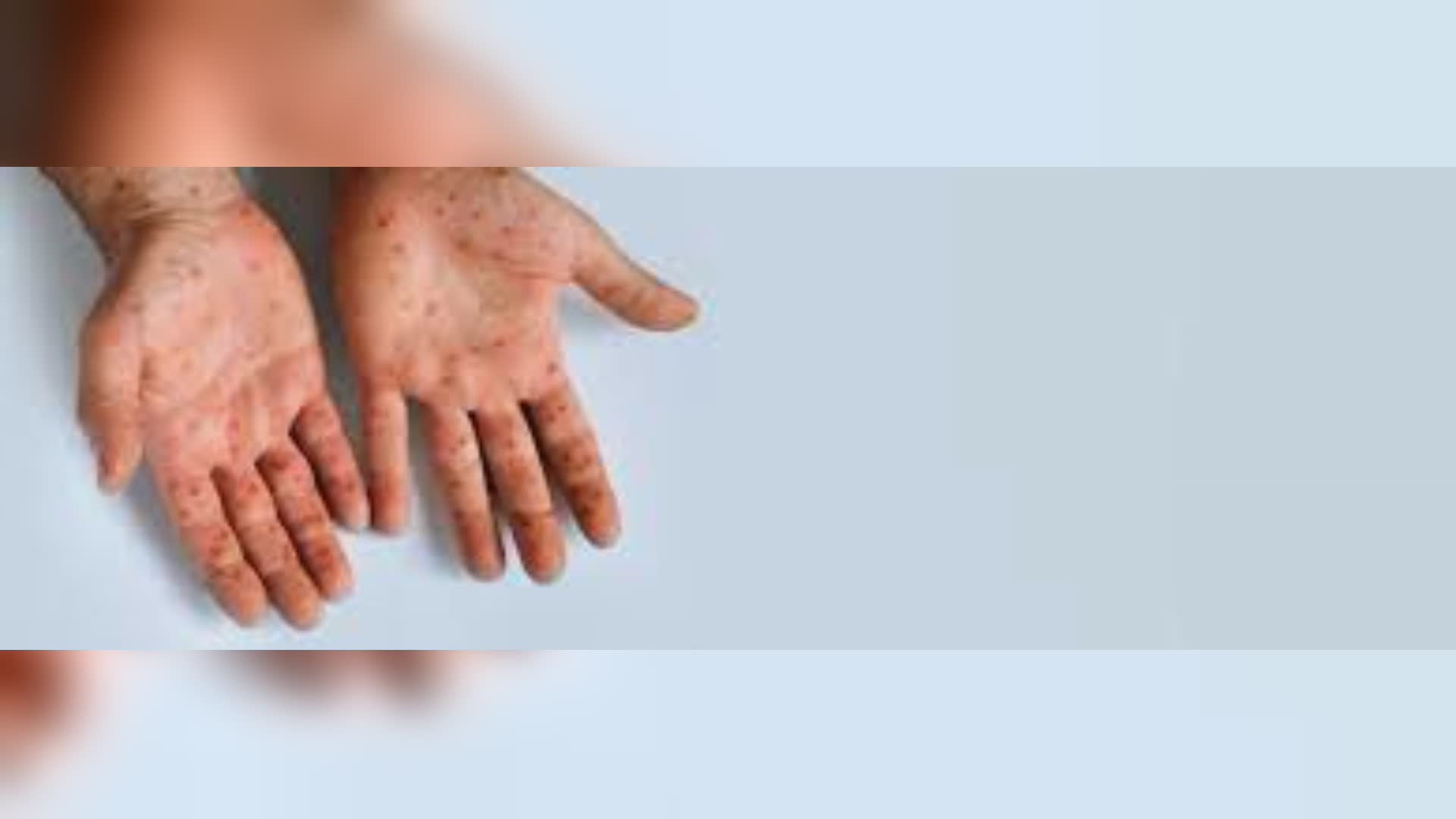 Morbillo, altri due casi nel savonese: Asl 2 invita a vaccinarsi