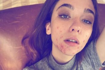 Matilda De Angelis:" Fiera delle mie cicatrici. Non mi importa essere bella"