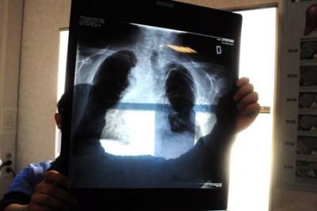 Alla ricerca dei marcatori per la diagnosi precoce del tumore al polmone causato dal Radon