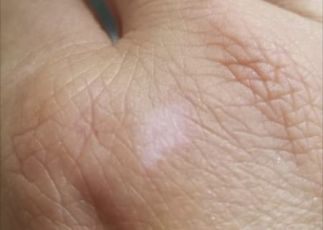 25 giugno, è la Giornata Mondiale della vitiligine