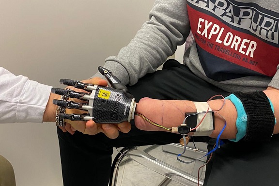La Spezia, una protesi bionica ridà la mano a un 18enne: può usare anche il touch screen