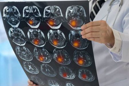 Giornata Mondiale contro l'Ictus, un'alleanza per rafforzare i servizi al malato