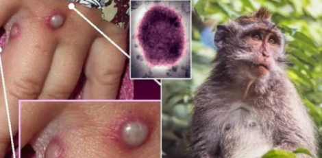 Vaiolo delle scimmie, in arrivo per le Regioni la seconda tranche di vaccini