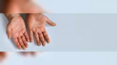 Morbillo, altri due casi nel savonese: Asl 2 invita a vaccinarsi