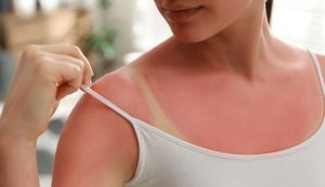 Scottarsi per fare 'like' sui social, l'assurda 'SunBurn Challenge' contagia anche l'Italia. L'esperta: "Rischi enormi per la salute"