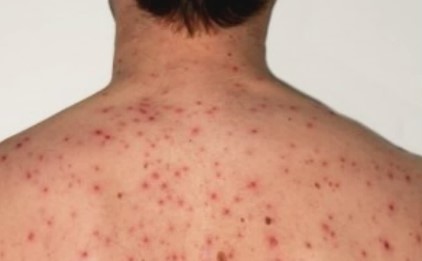 Liguria, morbillo: registrati 12 casi dal 1° settembre, alta incidenza di non vaccinati