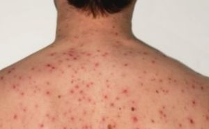 Liguria, morbillo: registrati 12 casi dal 1° settembre, alta incidenza di non vaccinati